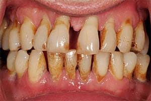 ” إحذر عشان صحتك” 9 علامات خطيرة تظهر في الفم بسبب مرض السكري