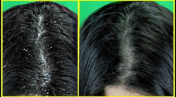 النتيجة مضمونة.. تخلص من قشرة الشعر نهائيًا بأقوى الوصفات الطبيعية المجربة من أول أستعمال